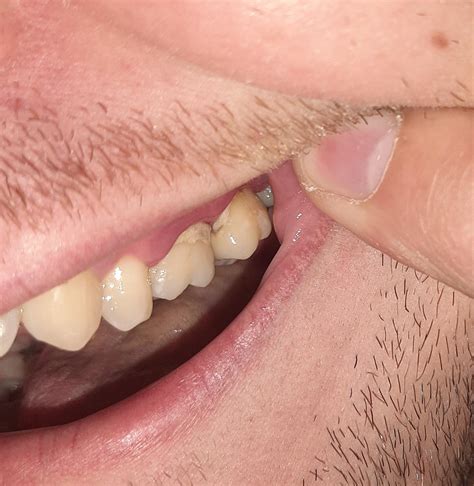 r/askdentists|Ask Dentists .